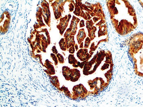 IHC of PSMA on an FFPE Prostate Adenocarcinoma Tissue